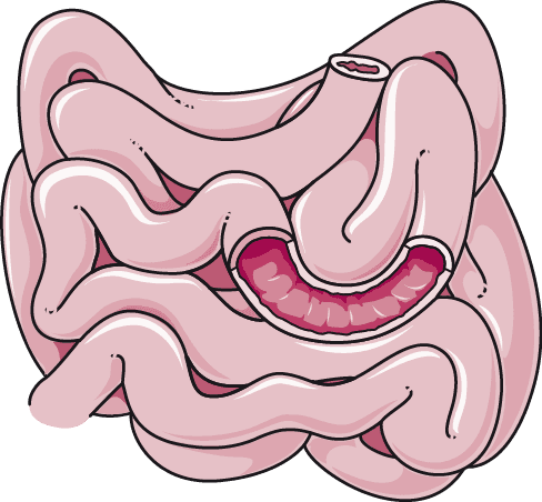 Choroba Leśniowskiego-Crohna: Nieswoiste zapalenie jelit o nieznanej etiologii