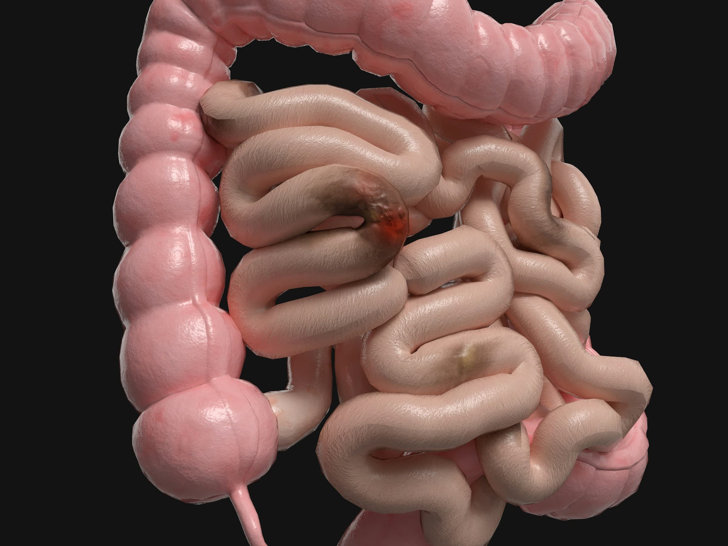 Panel Gastro – test panelowy układu pokarmowego wykrywający 25 patogenów jelitowych